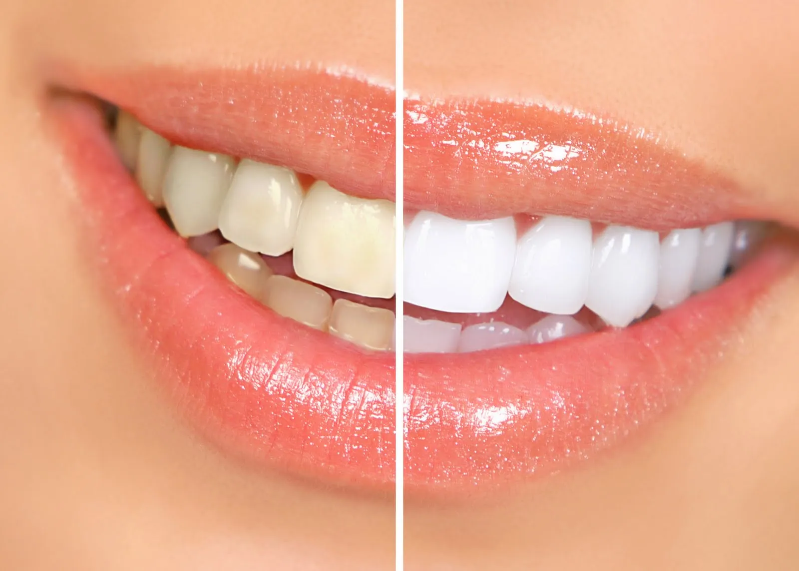 Comparação de dentes antes e depois do clareamento