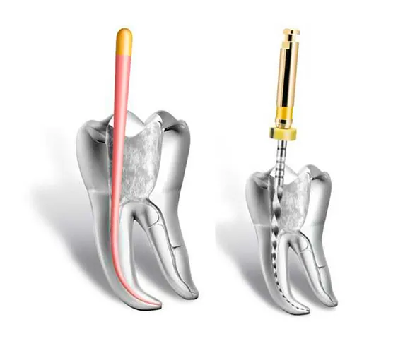 Endodontia mecanizada