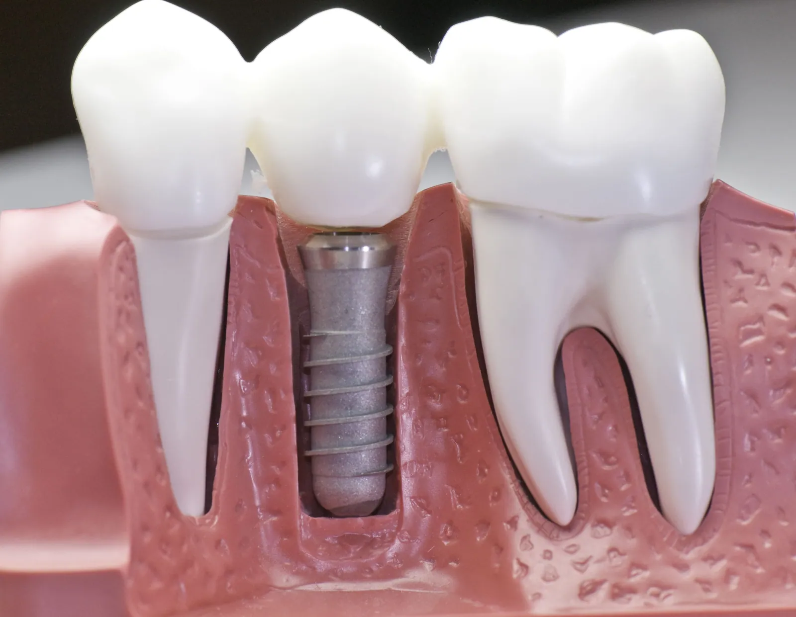 Ilustração de implante dentário entre dentes naturais