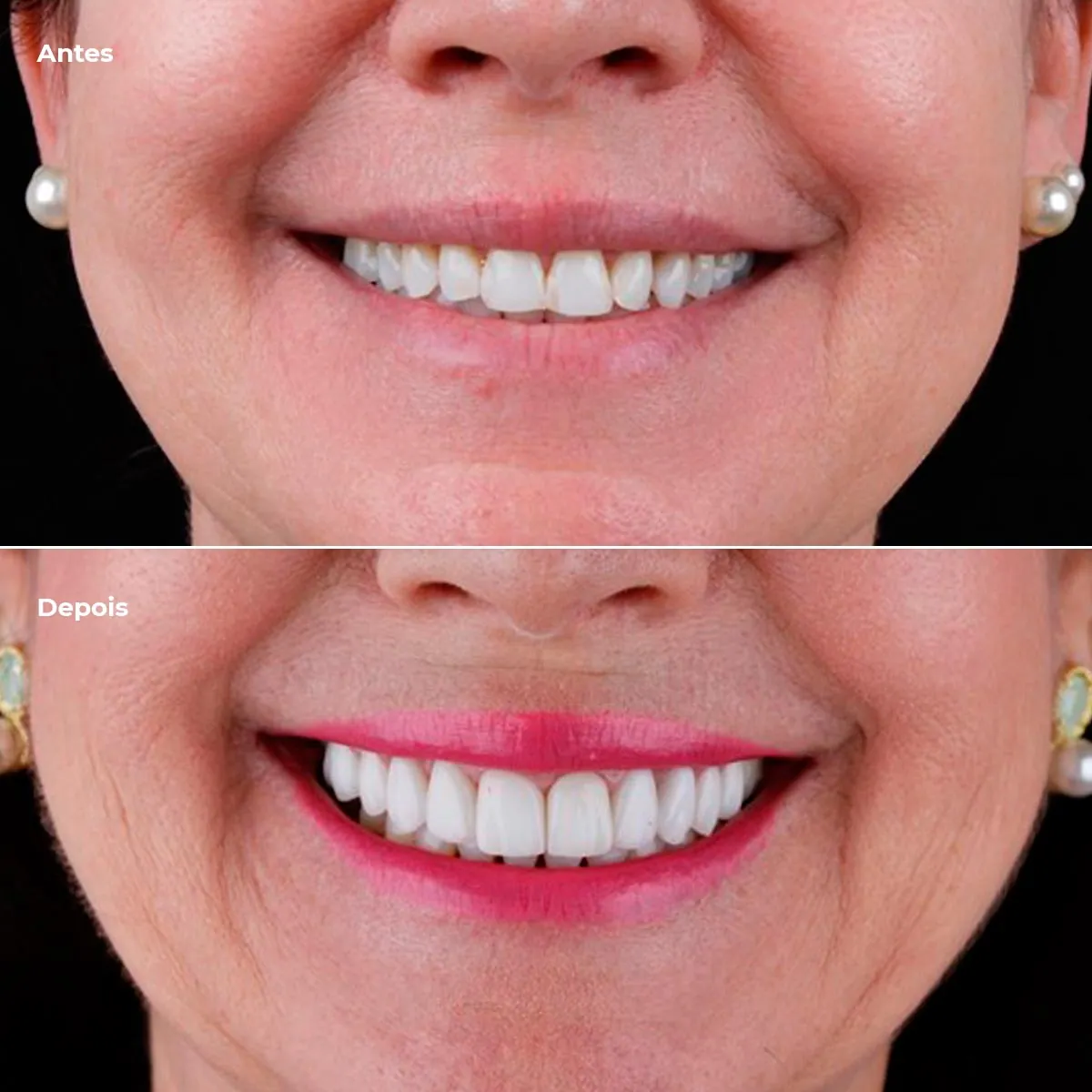 Antes e depois de facetas em um caso da clínica