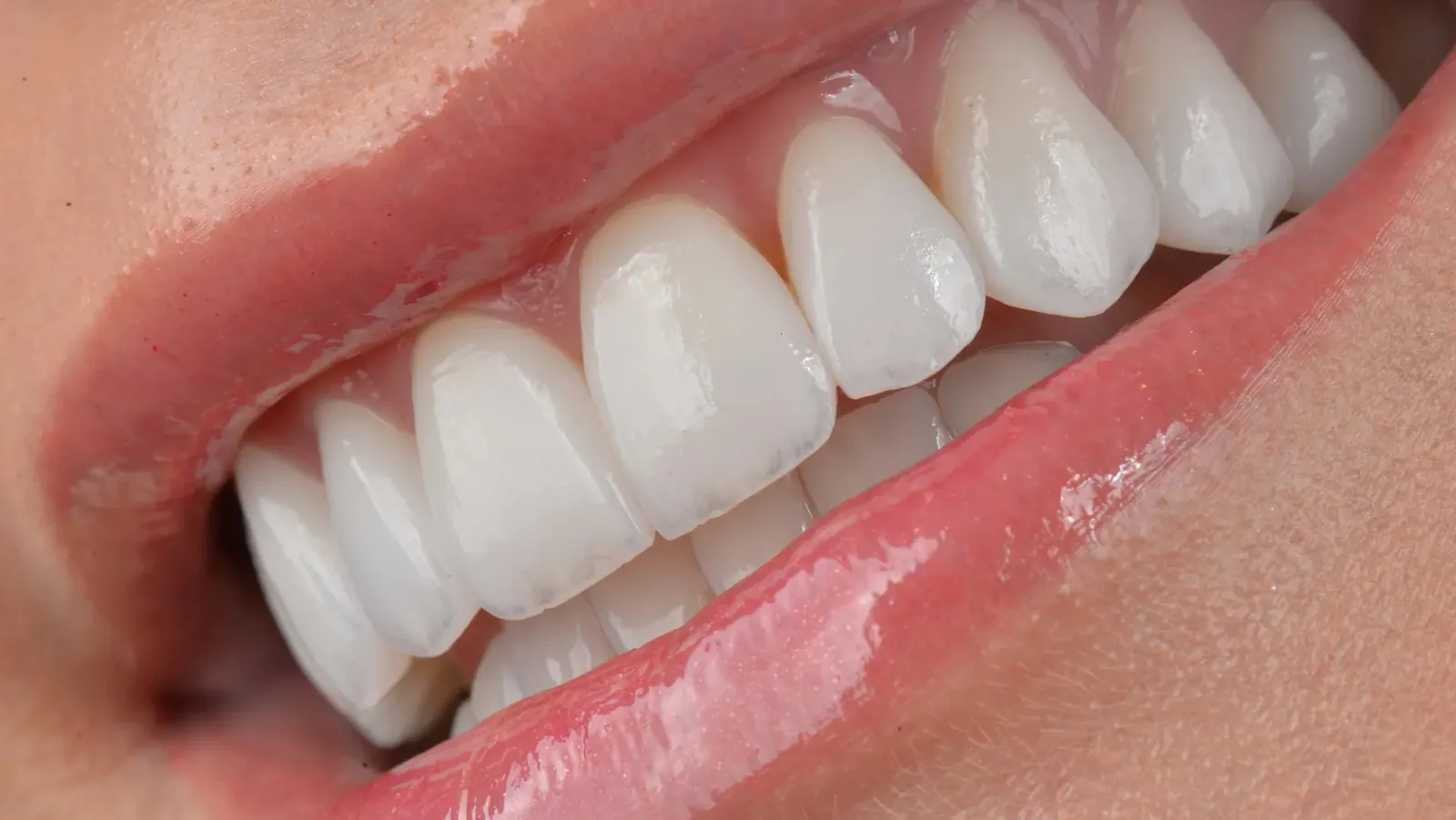 Sorriso com lentes de contato dental