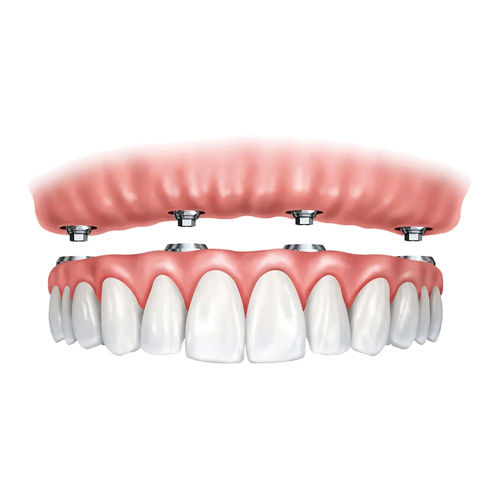 Modelo de prótese protocolo sobre implantes