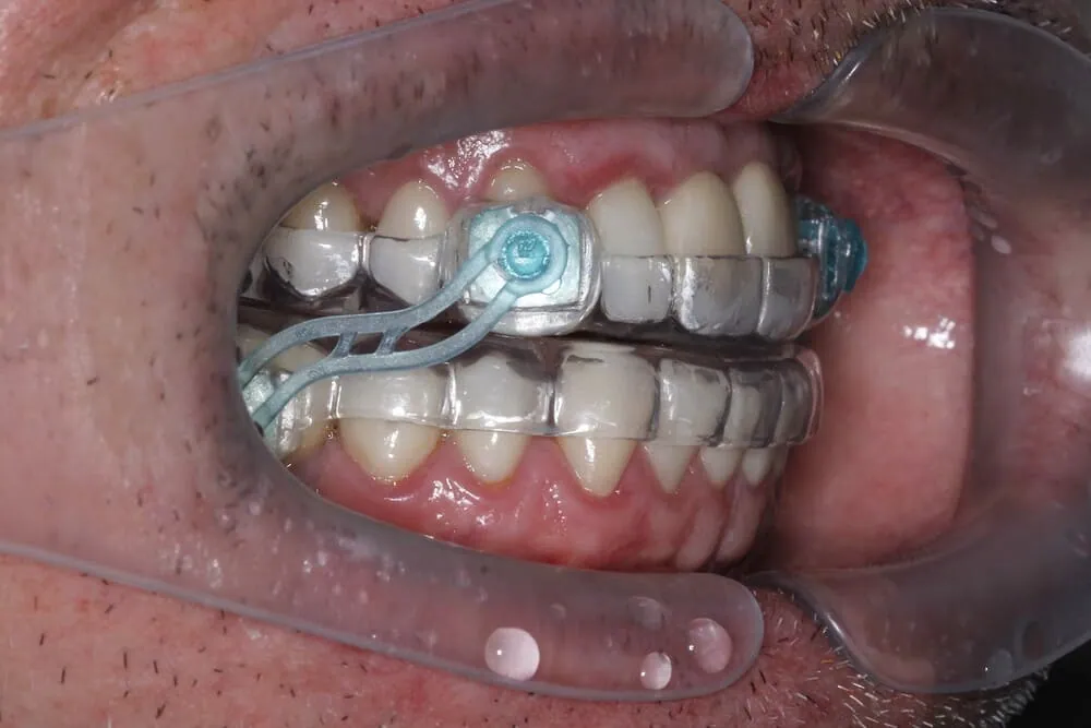 Placa intraoral para ronco e apneia