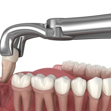 Cirurgia Oral Menor