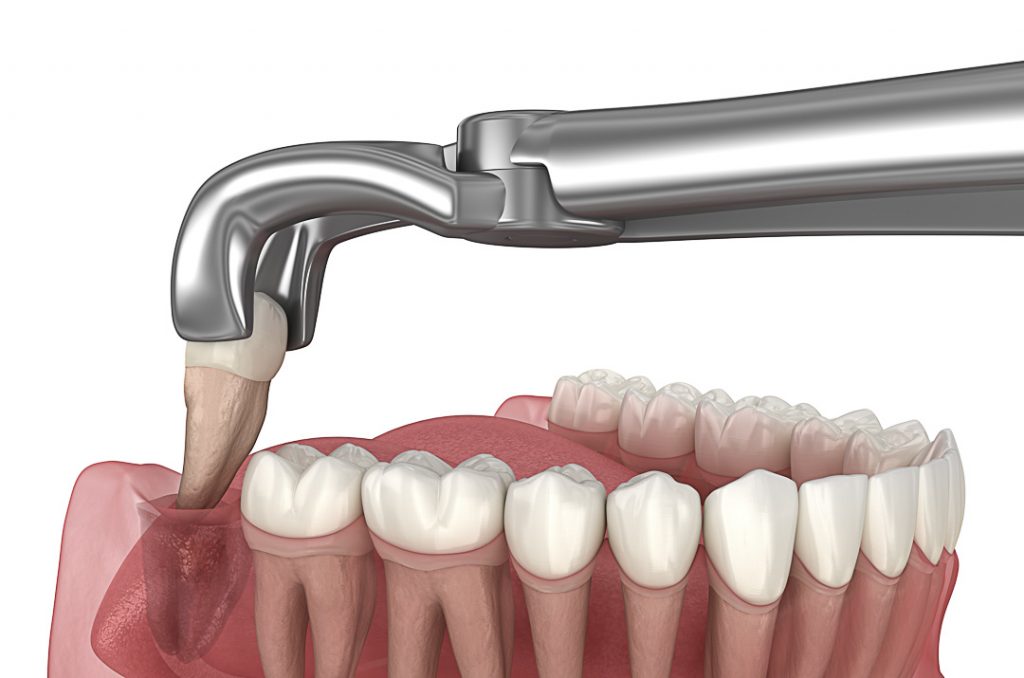 Cirurgia Oral Menor