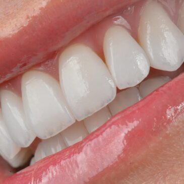 Lentes de Contato Dental: o que são e quando são indicadas