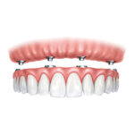 protese-protocolo-clinica-ichiban-londrina