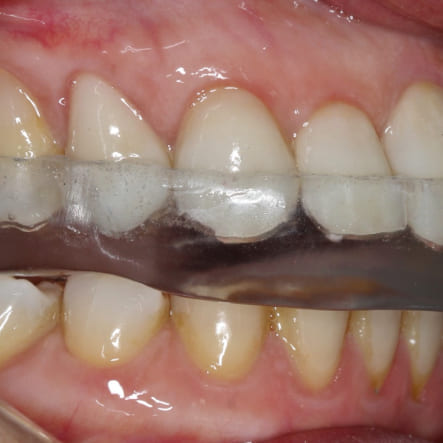 placa-de-bruxismo-dentista-em-londrina-pr