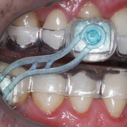 placa-para-ronco-em-londrina-dentista-clinica-ichiban