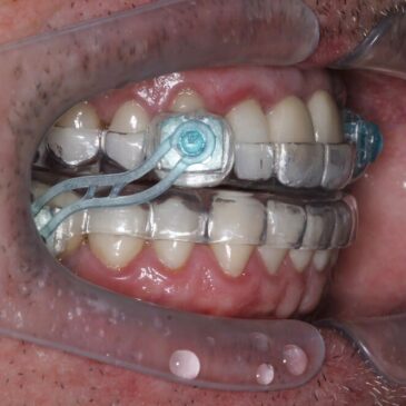 Placa para ronco e apneia do sono: Como funciona e quem pode usar?